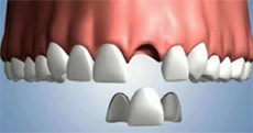 Bridges at Claremorris Dental Care