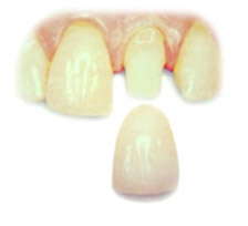 Crowns at Claremorris Dental Care Crowns at Claremorris Dental Care