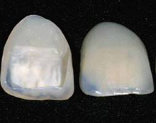Veneers at Claremorris Dental Care Veneers at Claremorris Dental Care