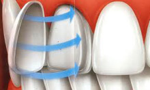 Veneers at Claremorris Dental Care Veneers at Claremorris Dental Care