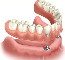 Implants at Claremorris Dental Care